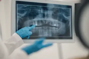 Dental Xray Dental Xray