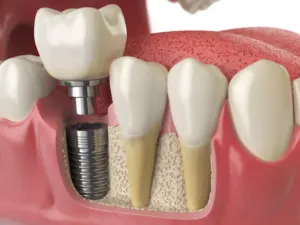 Anatomy Of Healthy Teeth And Tooth Dental Implant Anatomy Of Healthy Teeth And Tooth Dental Implant