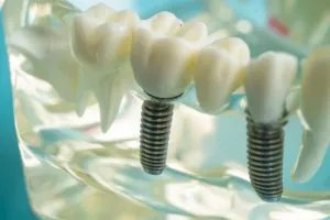 Dental Implant Artificial Tooth Roots Into Jaw Dental Implant Artificial Tooth Roots Into Jaw