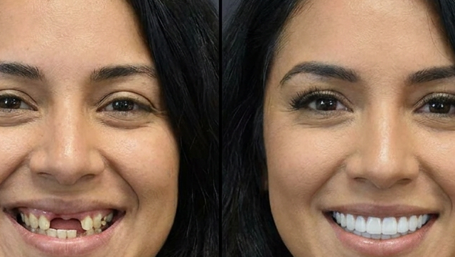 Quality Dentures + Implants All On X Dental Implants Quality Dentures + Implants All On X Dental Implants